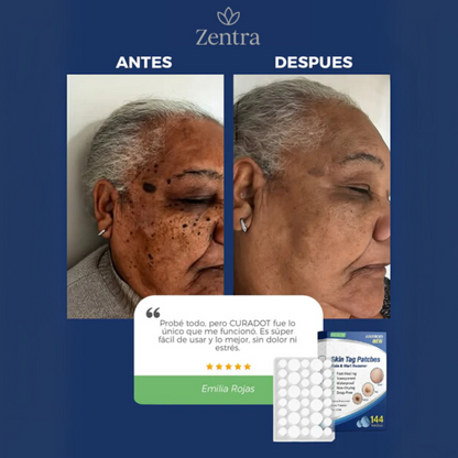 PACK 144 UND | REMOVEDOR DE VERRUGAS Y LUNARES CON 5 MINUTOS AL DÍA - CURADOT®