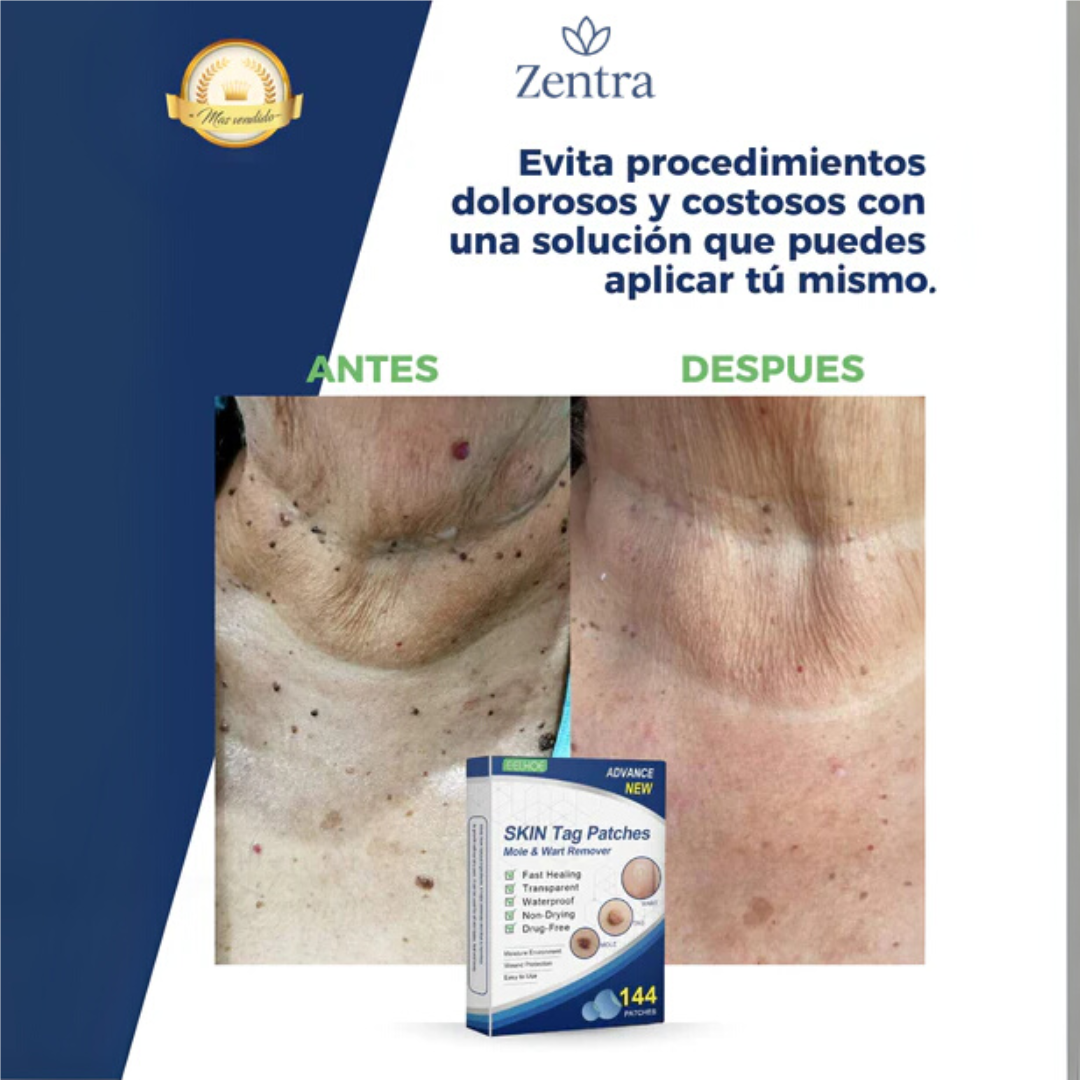 PACK 144 UND | REMOVEDOR DE VERRUGAS Y LUNARES CON 5 MINUTOS AL DÍA - CURADOT®