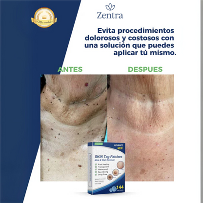PACK 144 UND | REMOVEDOR DE VERRUGAS Y LUNARES CON 5 MINUTOS AL DÍA - CURADOT®